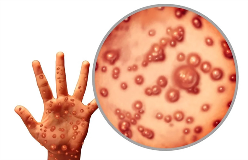 थप एक नेपालीमा मंकिपक्स पुष्टि