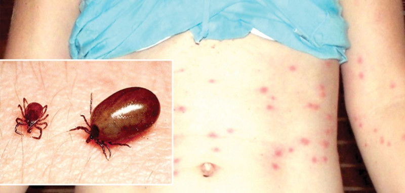 बढ्दै स्क्रब टाइफसका बिरामी